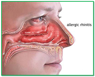 sinus treatment in ayurveda