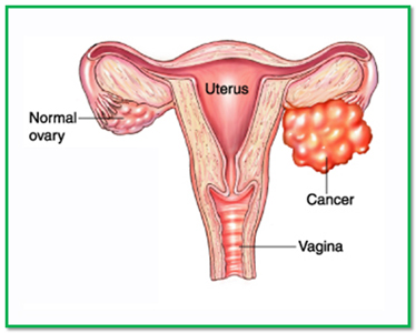 Image result for image of ovarian cancer