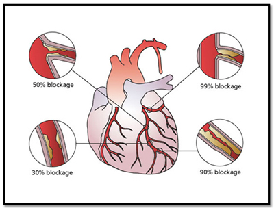 Artery Blockage